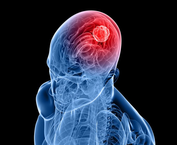 Le cerveau et la tumeur cerebrale : les idees recues