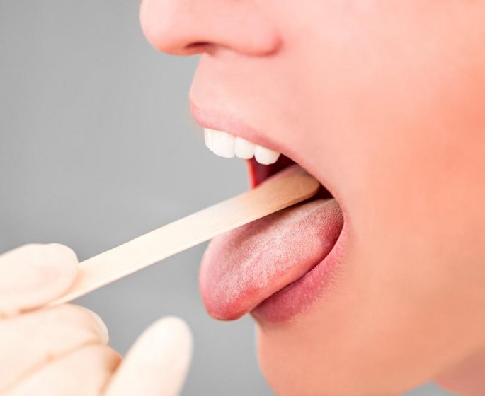 Quels sont les symptomes du cancer de la langue ? 