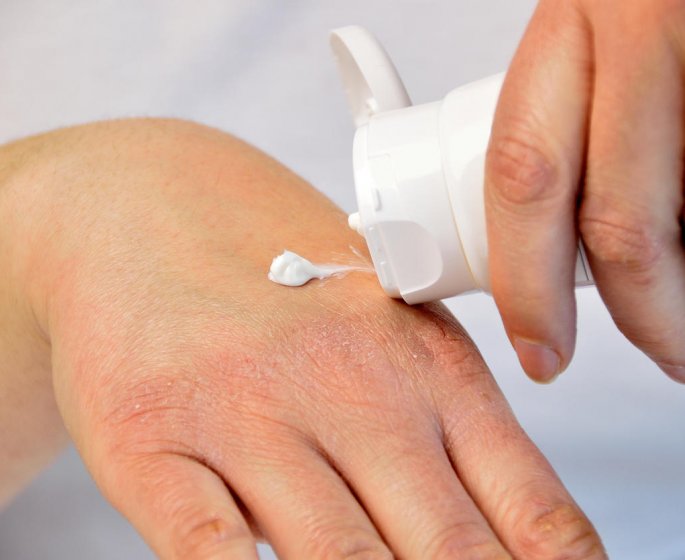 6 effets que peut avoir la cortisone sur votre peau