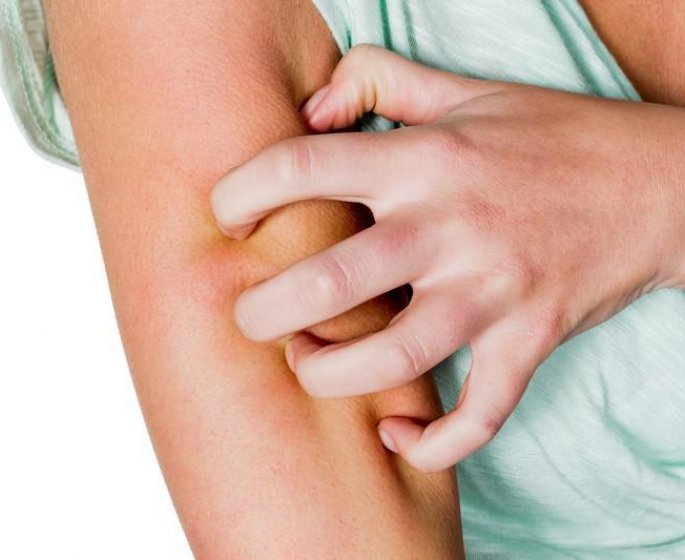 Vivre avec un psoriasis