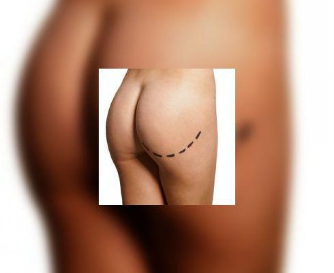 La liposuccion : qui, quoi et comment ?