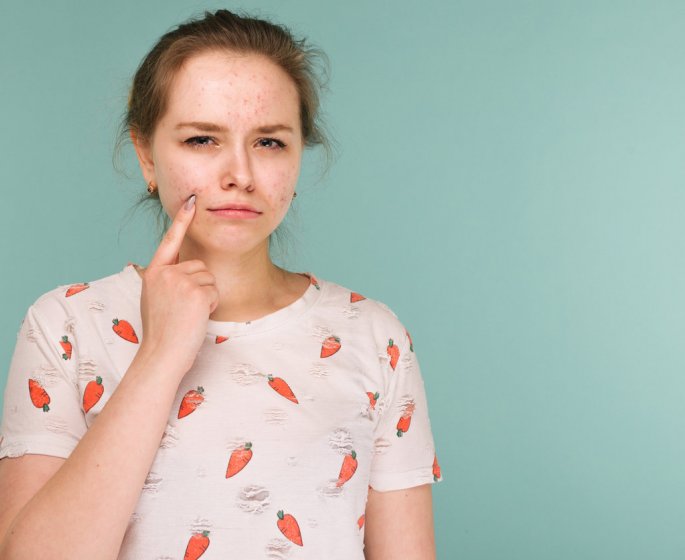 Les differents visages de l-acne