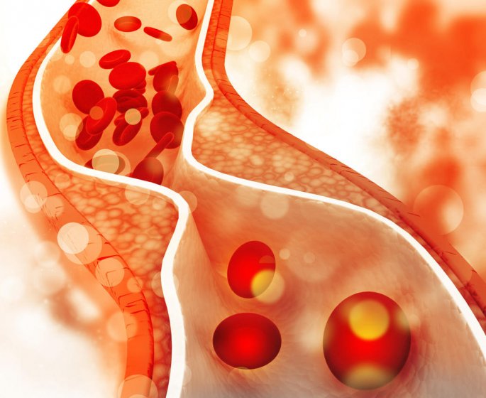 Les principaux symptomes d-un exces de cholesterol