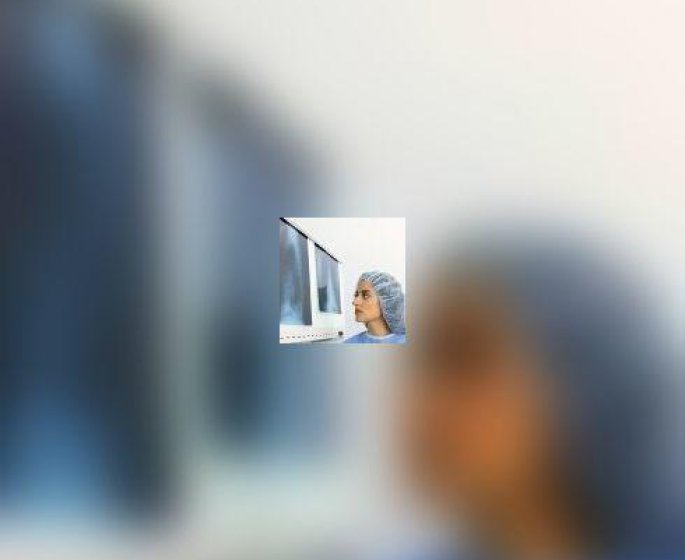Chondrosarcome, cancer des os, cancer du cartilage