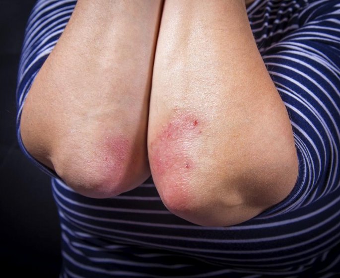 Psoriasis : la maladie de peau la plus genante pour les Francais