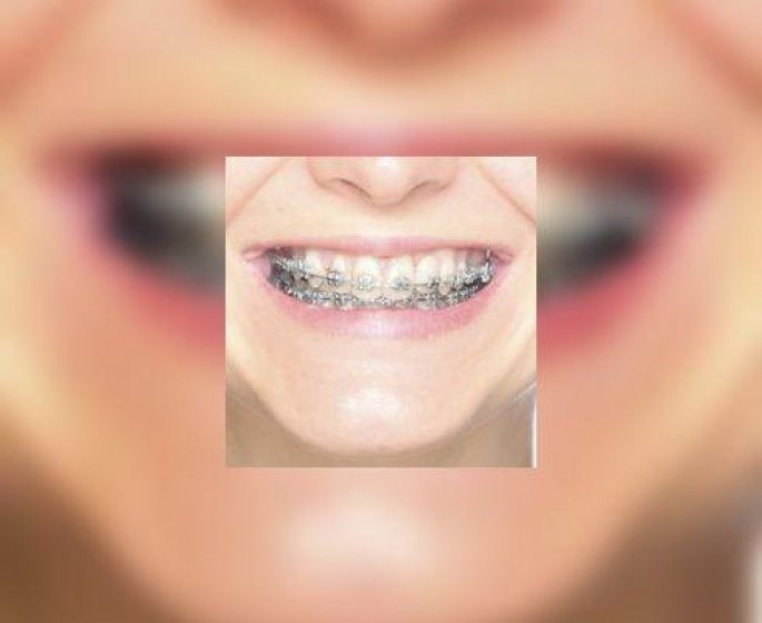 Orthodontie : les appareils dentaires « faits maison » sont a proscrire