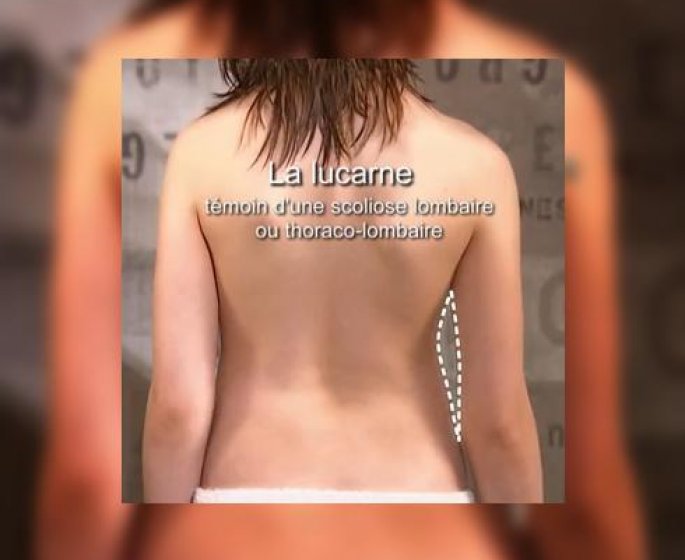 Scoliose : aux parents de la depister tot !