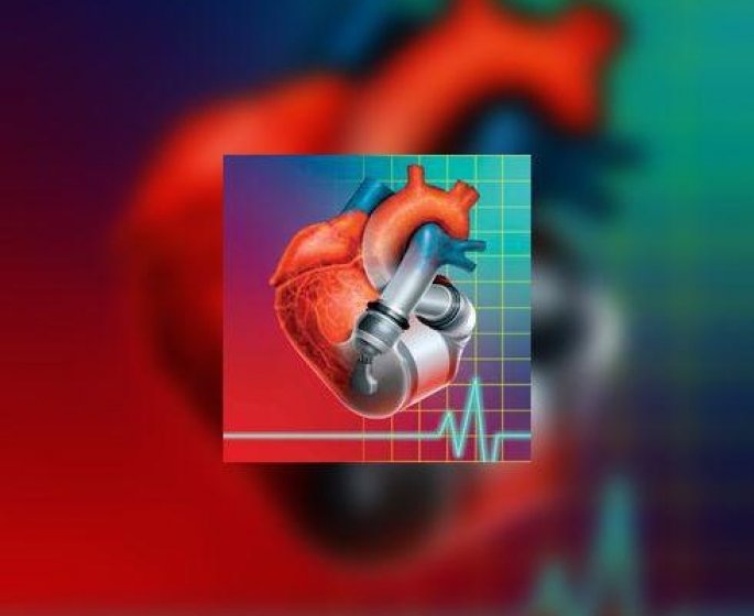 Deuxieme implantation de cœur artificiel