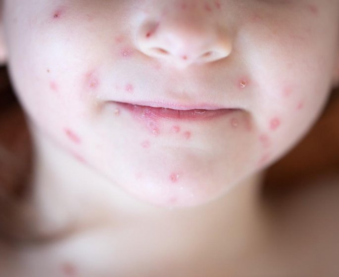 Plusieurs regions touchees par une epidemie de varicelle 