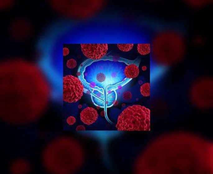Cancer localise de la prostate : faut-il traiter ou pas ?
