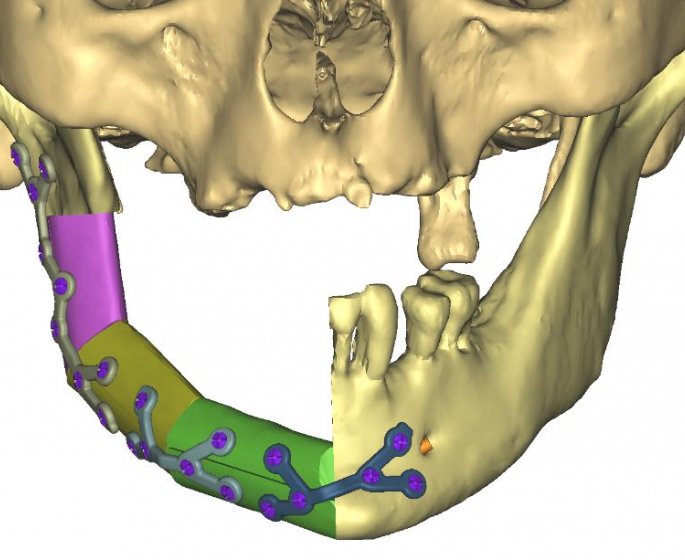 Lyon : des chirurgiens utilisent la 3D pour reconstruire une machoire