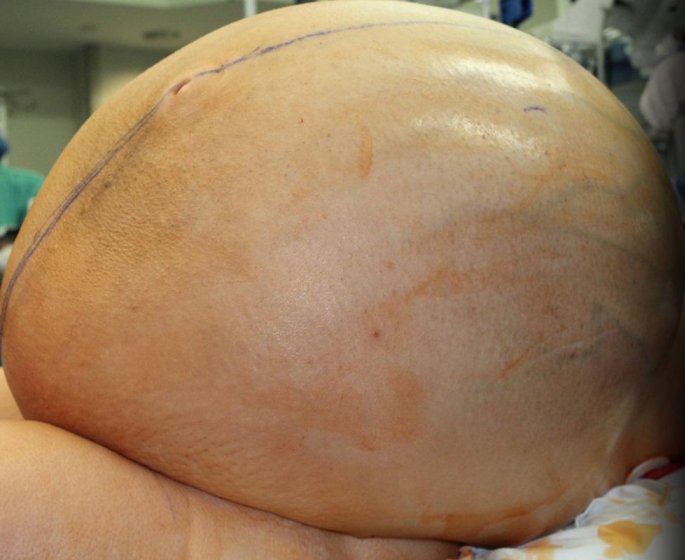 Une femme operee pour une tumeur aux ovaires de 60 kilos !