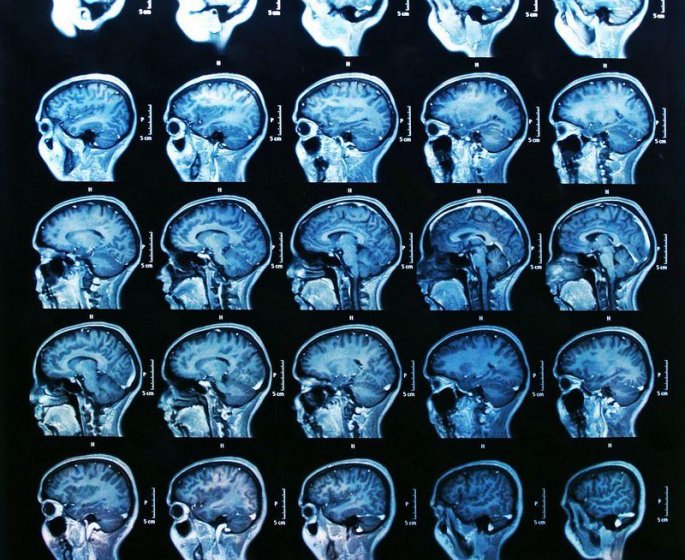 Et si le stress reduisait la taille du cerveau ?