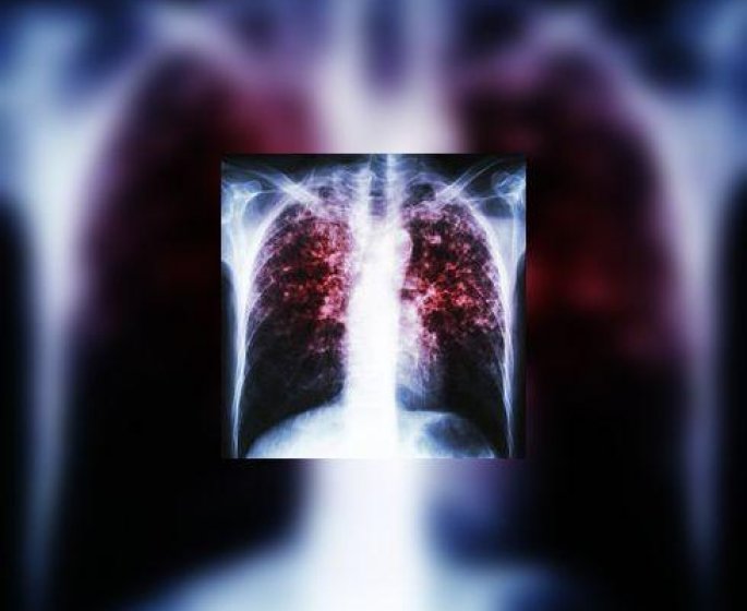 Tuberculose : bientot un test respiratoire ?