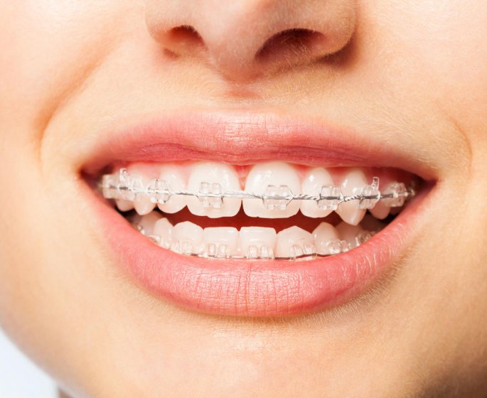 Les appareils orthodontiques, nids a bacteries dans la bouche ?