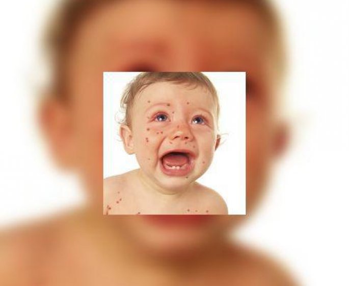 Epidemie de rougeole : verifiez vos vaccins !