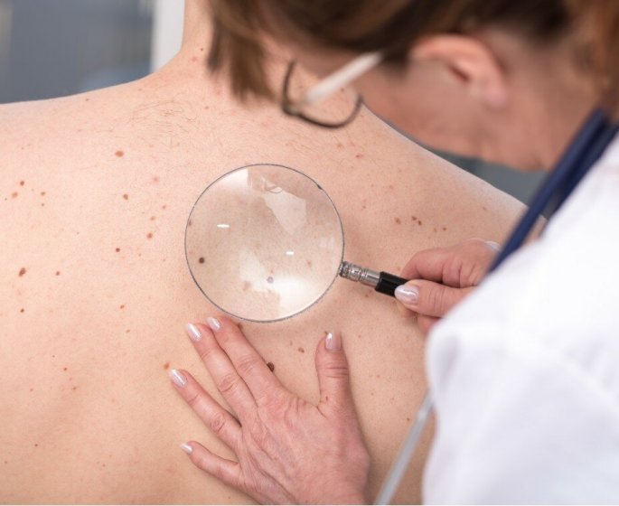 Cancer de la peau : ces 5 signes qui doivent inquieter