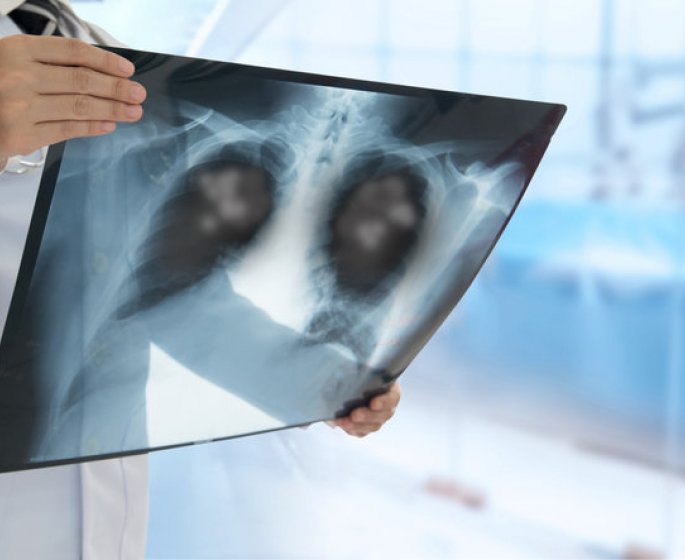 Cancer du Poumon : les 10 departements ou il tue le plus de femmes