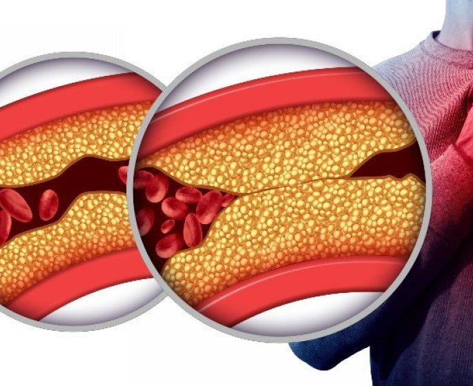 Atherosclerose : 5 signes que vos arteres sont bouchees