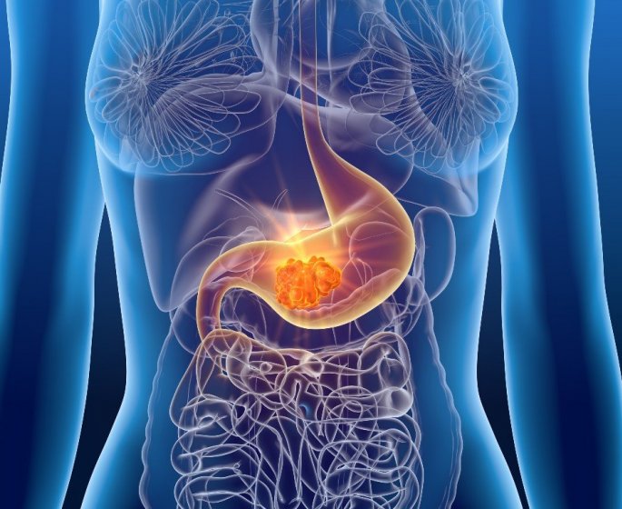 Cancer de l’estomac : 8 signes precurseurs qui doivent alerter