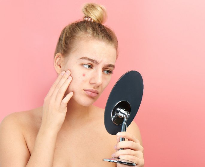 Acne, probleme de peau : 5 aliments qui donnent des boutons