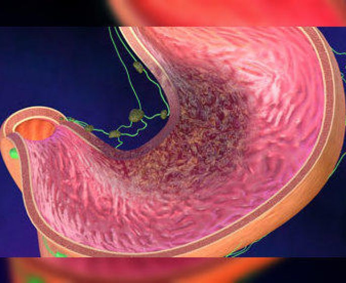 A quoi reconnait-on un cancer de l-estomac ?