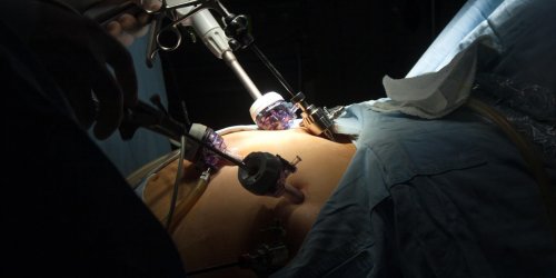 Chirurgie de l-obesite : faut-il maigrir a tout prix avec l-anneau gastrique ?