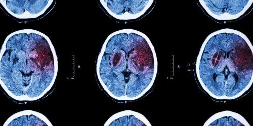 Accident vasculaire cerebral : qu-est-ce qu-un AVC ischemique ?