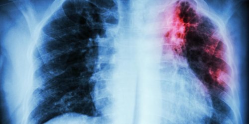 Tuberculose : inquietante hausse des cas en ile-de-France