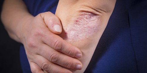 Psoriasis des coudes et genoux : quelles solutions et traitements ?