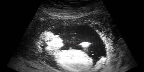 Douleurs pelviennes : un fœtus s’etait en fait developpe dans sa vessie 