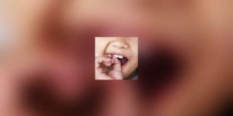 Dent arrachee ou dent luxee : il y a urgence !