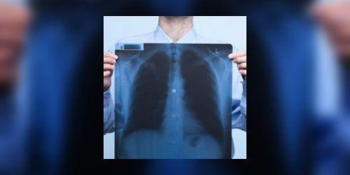 Aspergillose : attaque fongique des poumons 