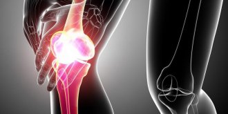 Arthrose : quels traitements ?