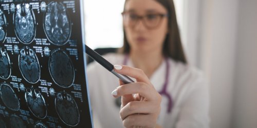 Anevrisme cerebral : quels sont les symptomes ?