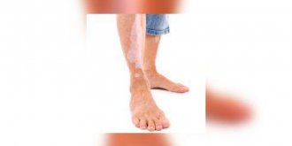 Vitiligo : quand la peau perd sa couleur