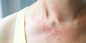 Boutons Comment Distinguer Allergie Stress Et Maladie De Peau