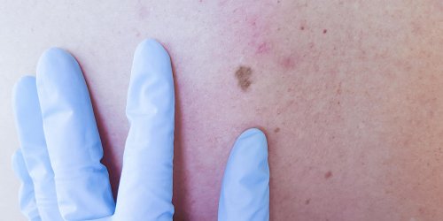 Cancer de la peau : le carcinome epidermoide