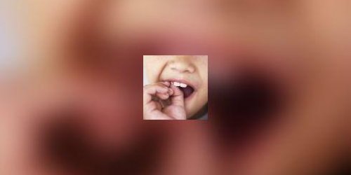 Dent cassee ou arrachee : c-est une urgence !