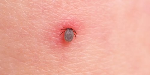 Maladie de Lyme : que faire en cas de morsure de tique ?