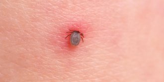 Maladie de Lyme : que faire en cas de morsure de tique ?