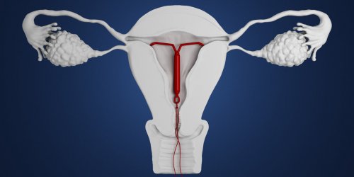 Contraception : trois sterilets suspendus par l’ANSM