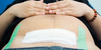 Cesarienne : prendre un selfie de votre cicatrice vous met en danger