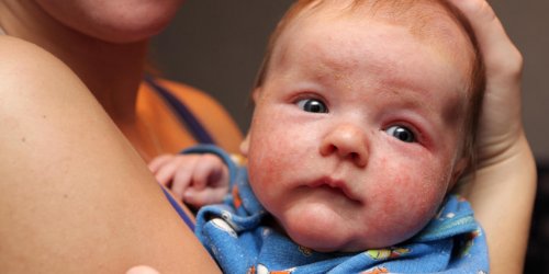 Bebe : eczema, dermatite atopique, quels symptomes, quels traitements ?
