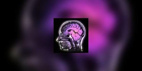 Un stimulateur cerebral pour les Parkinsoniens