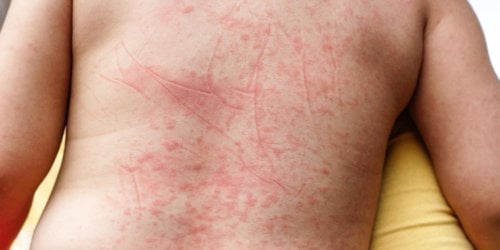 Purpura : taches rouges sur la peau, que se passe-t-il ? 