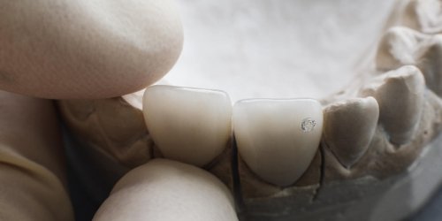 Couronne dentaire : comment choisir la bonne matiere