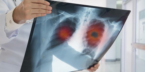 Les principaux symptomes du cancer du poumon