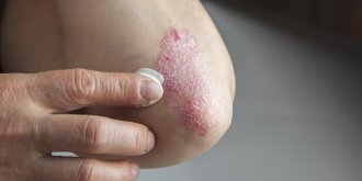 Psoriasis : 5 solutions naturelles