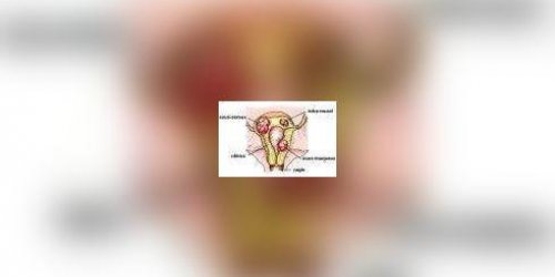 Ultrasons : nouveau traitement des fibromes uterins